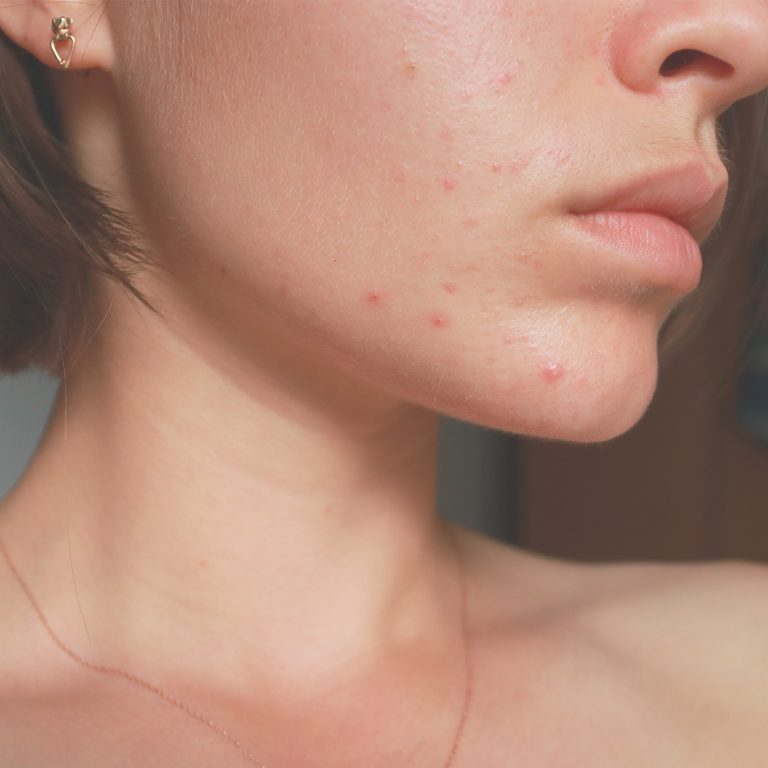 Acne Adulta