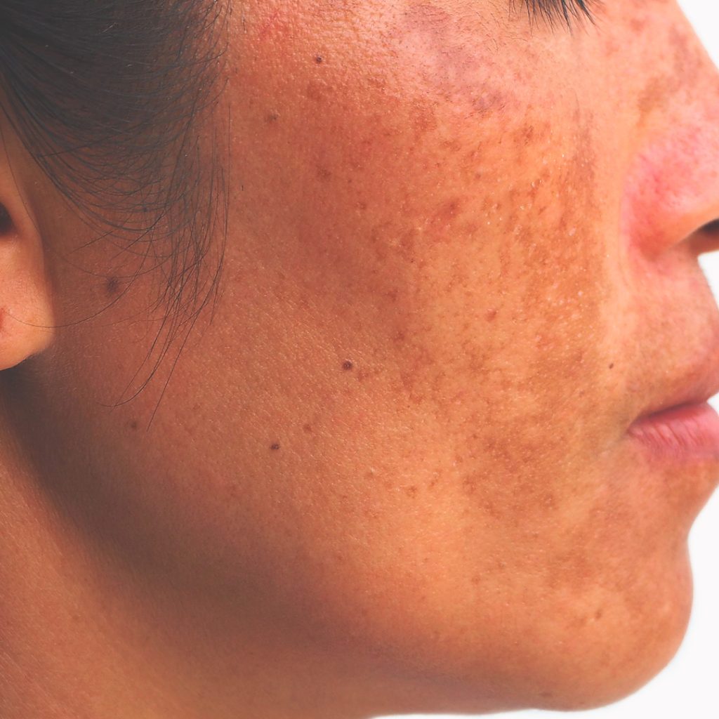 Melasma