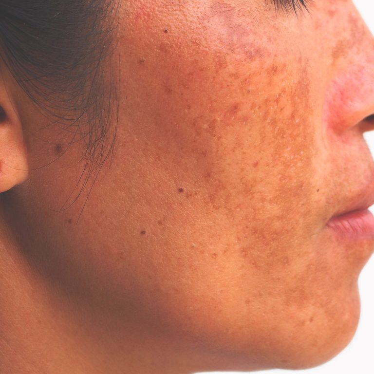 Tratamento de Melasma