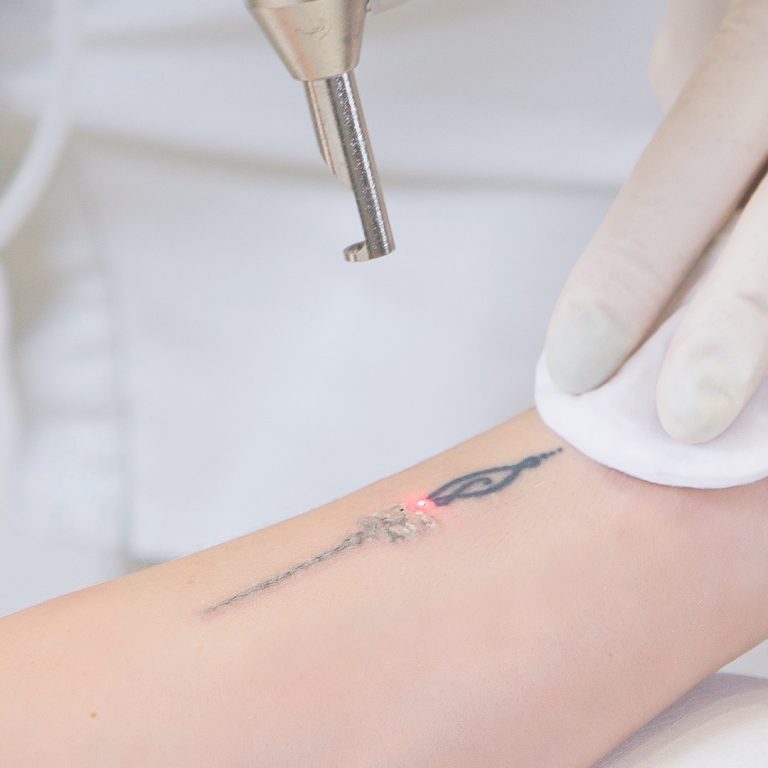 Remoção de tatuagem